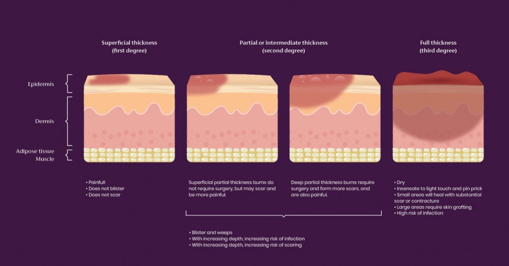 How To Care For Sunburn And Burn Scars Mederma®